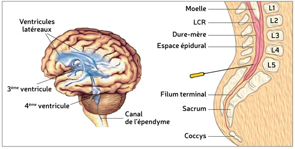 La ponction lombaire.
